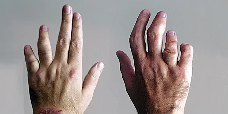 fig-1-psoriaticarthritishands