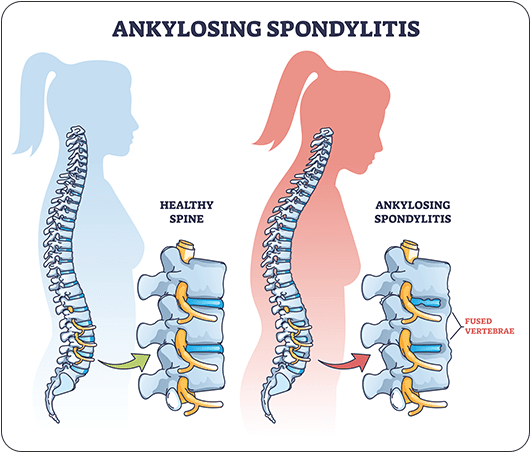 Ankylosing spondylitis spine treatment