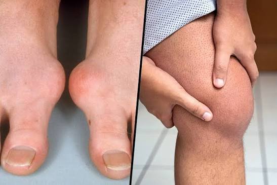 Gout and joint pain treatment consultation