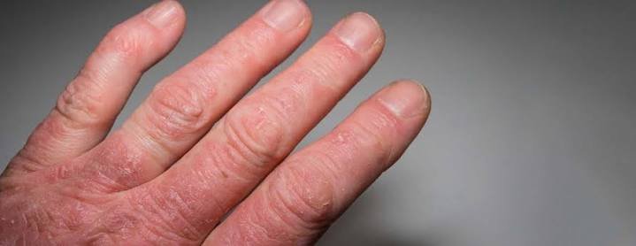Psoriatic arthritis treatment and rheumatology care