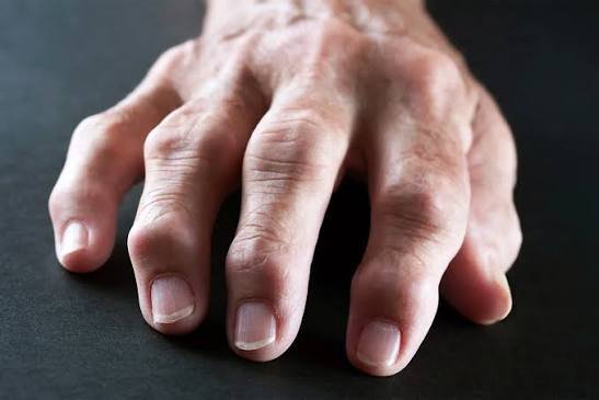 Rheumatoid arthritis consultation and treatment