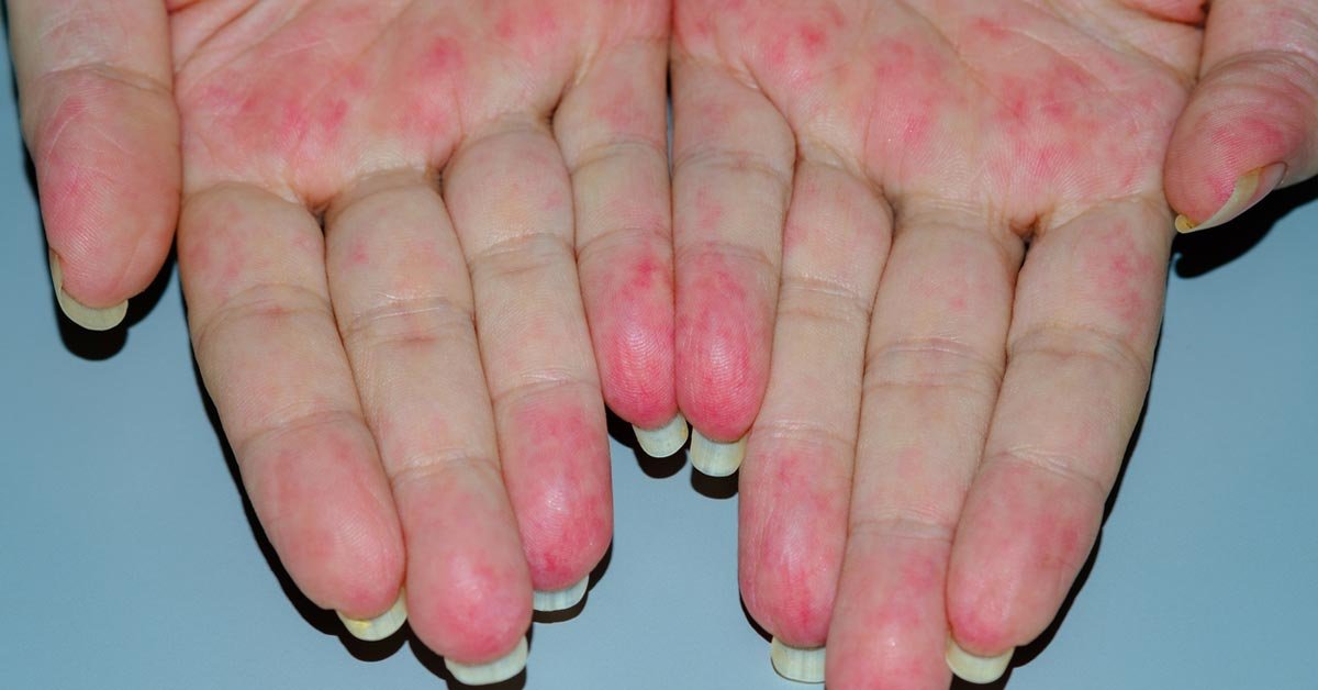 Myositis inflammatory muscle disease treatment